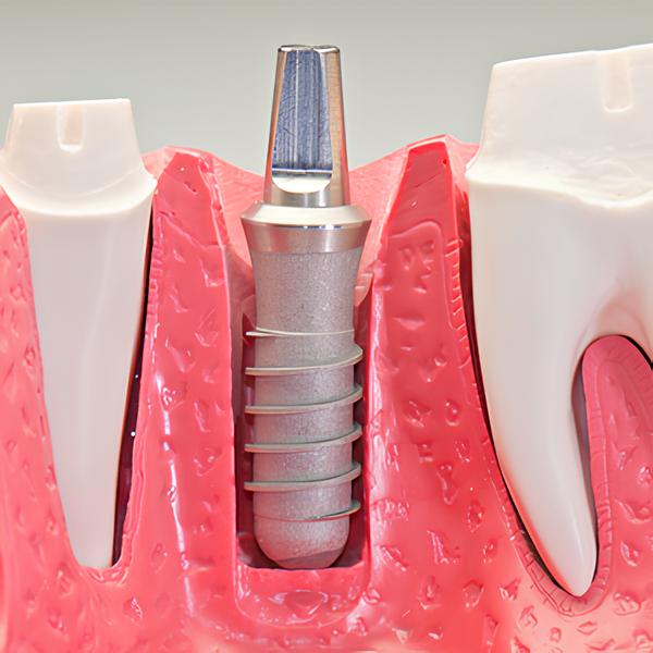 Dental Implants in Astoria, Queens