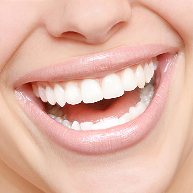 Teeth Whitening in Astoria, Queens